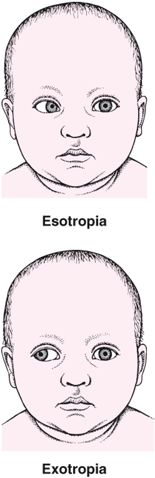 Estrabismo: um olho desalinhado