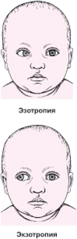 Страбизм: отклонение глаза