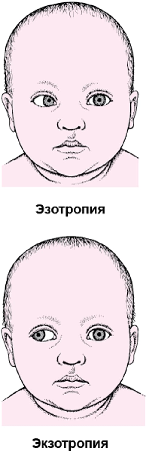 Страбизм: отклонение глаза