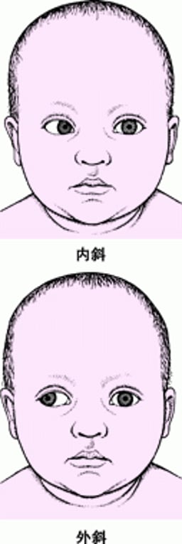 斜视：眼位不正的眼睛