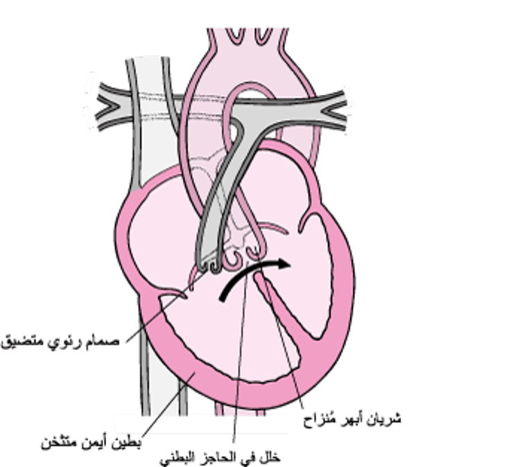 رُباعِيَّةُ فالو: العيوب الأربعة