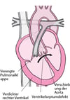 Fallot-Tetralogie: Vier Defekte