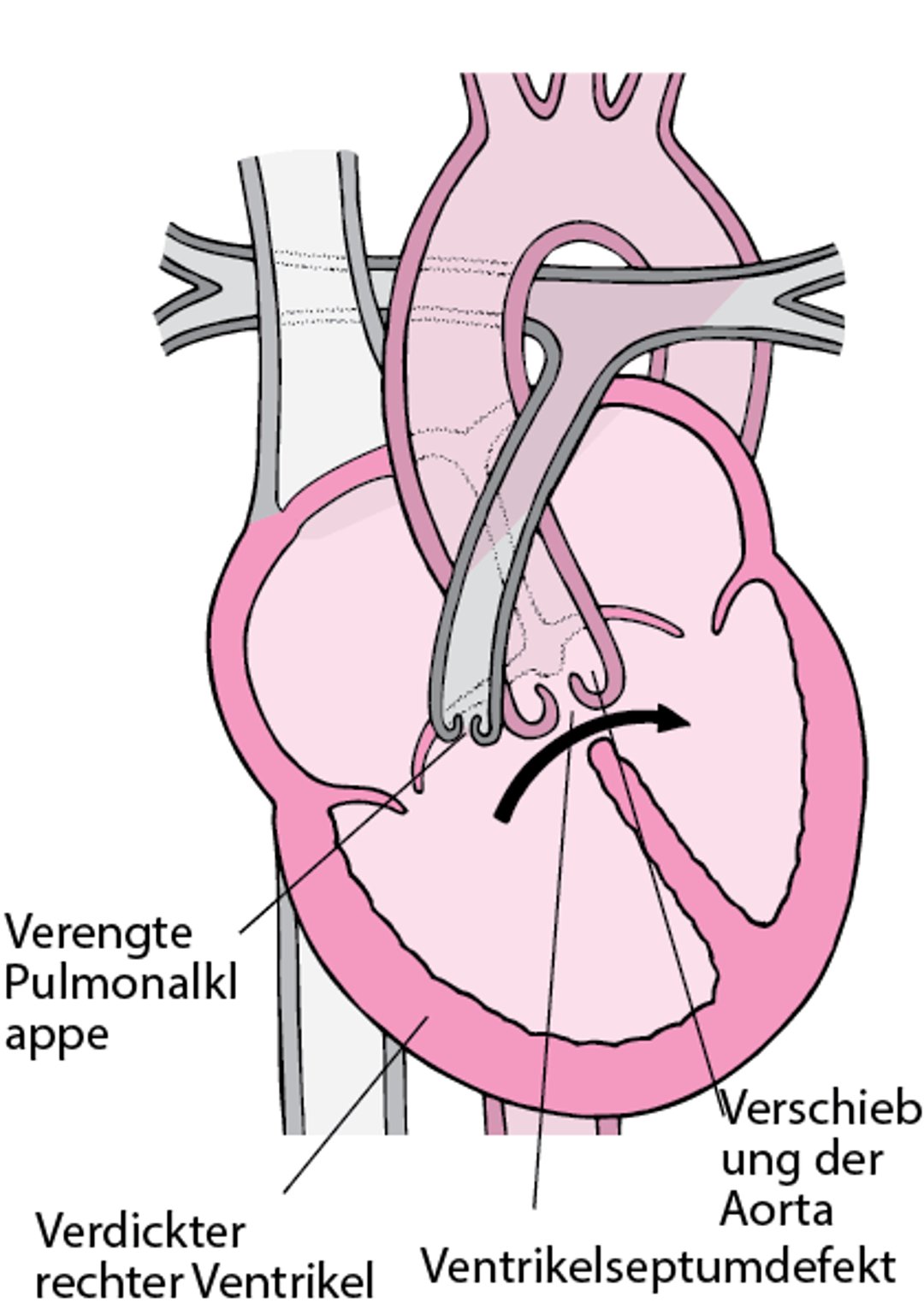 Fallot-Tetralogie: Vier Defekte