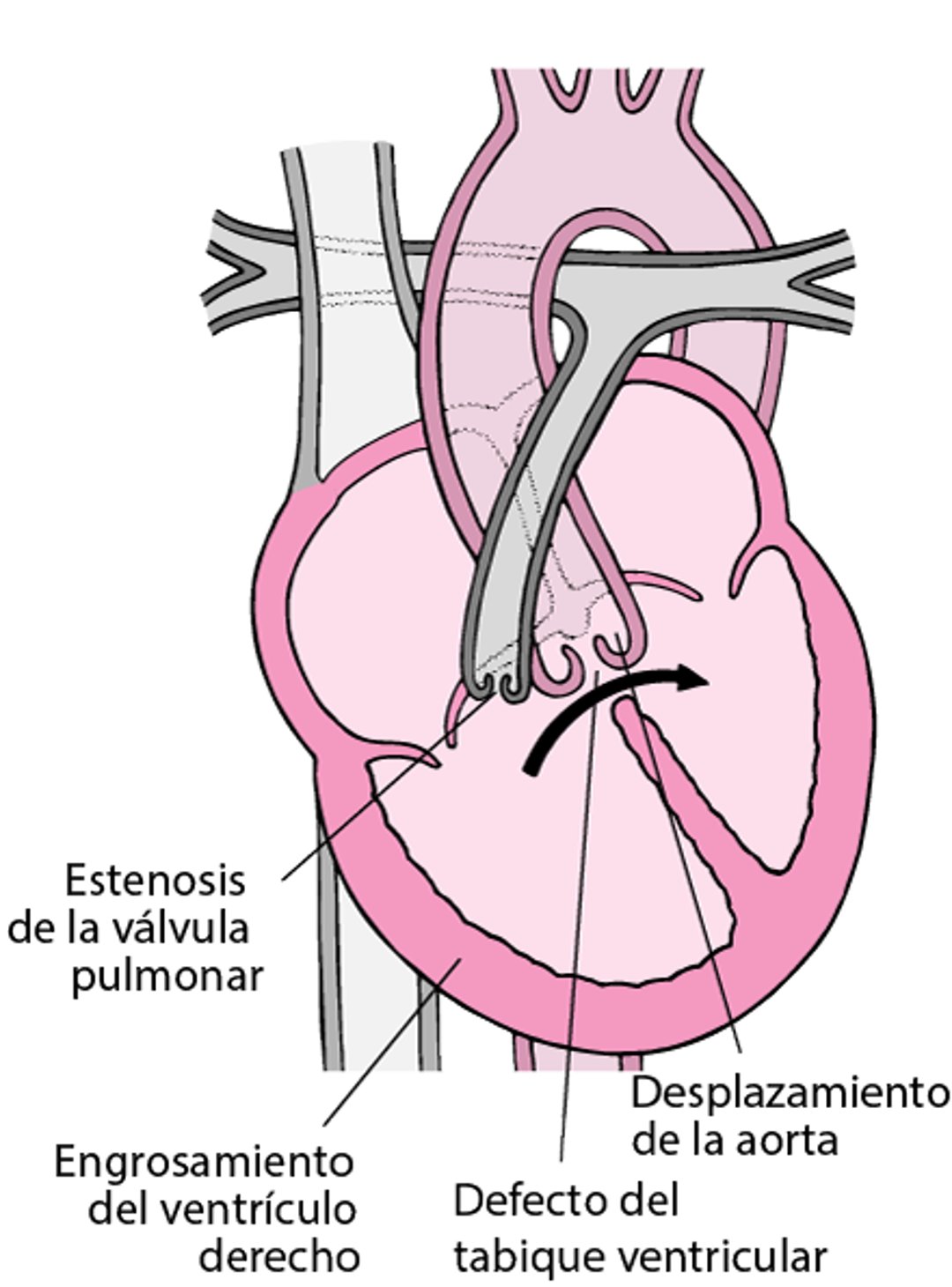 Tetralogía de Fallot: cuatro defectos