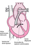 Tétralogie de Fallot : quatre malformations