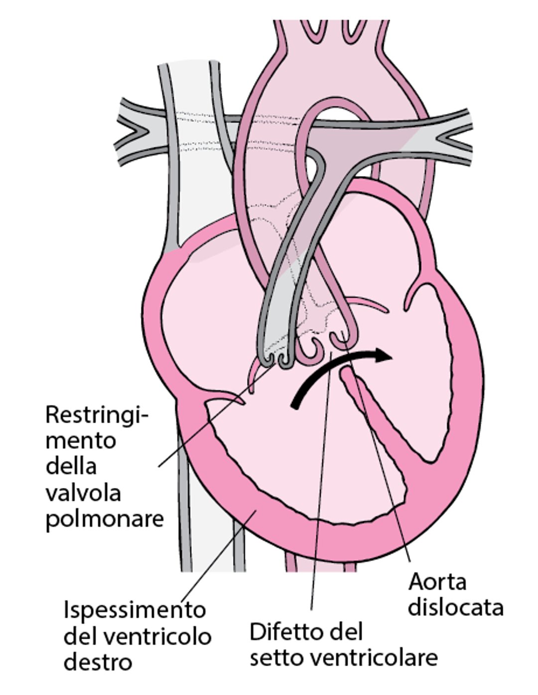 Tetralogia di Fallot: quattro difetti