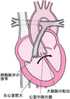 ファロー四徴症しちょうしょう：4つの異常いじょう
