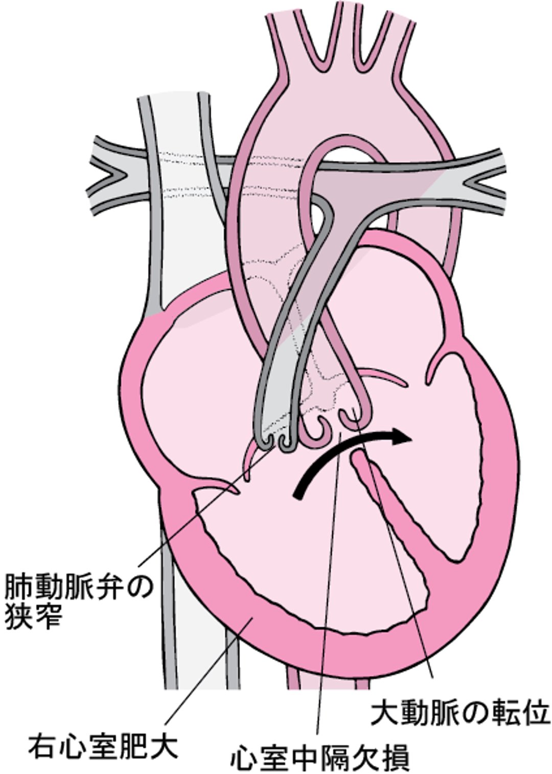 ファロー四徴症しちょうしょう：4つの異常いじょう