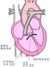팔로의 4대 징후: 4대 결손