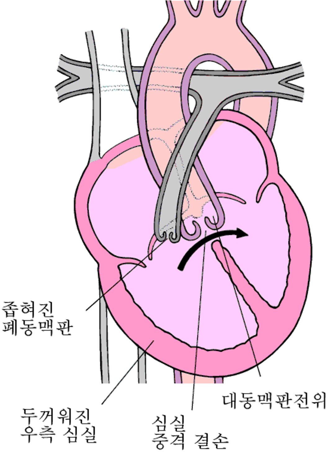 팔로의 4대 징후: 4대 결손