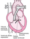 Tetralogia de Fallot: Quatro defeitos