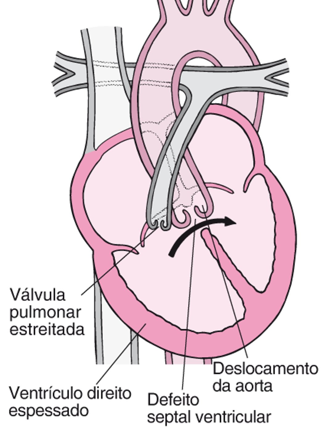 Tetralogia de Fallot: Quatro defeitos