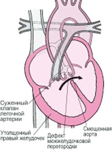 Тетрада Фалло: четыре дефекта