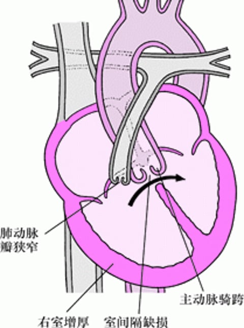 法洛四联症：四种缺陷