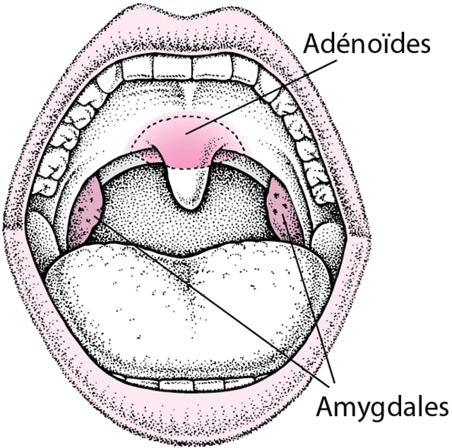 Maladies Ad no des Troubles Du Nez De La Gorge Et De L oreille maladies-ad-no-des-troubles-du-nez-de-la-gorge-et-de-l-oreille