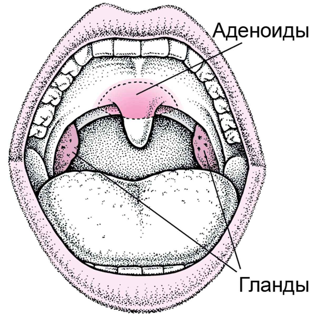 Расположение миндалин и аденоидов