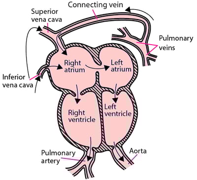 Total Anomalous Pulmonary Venous Return