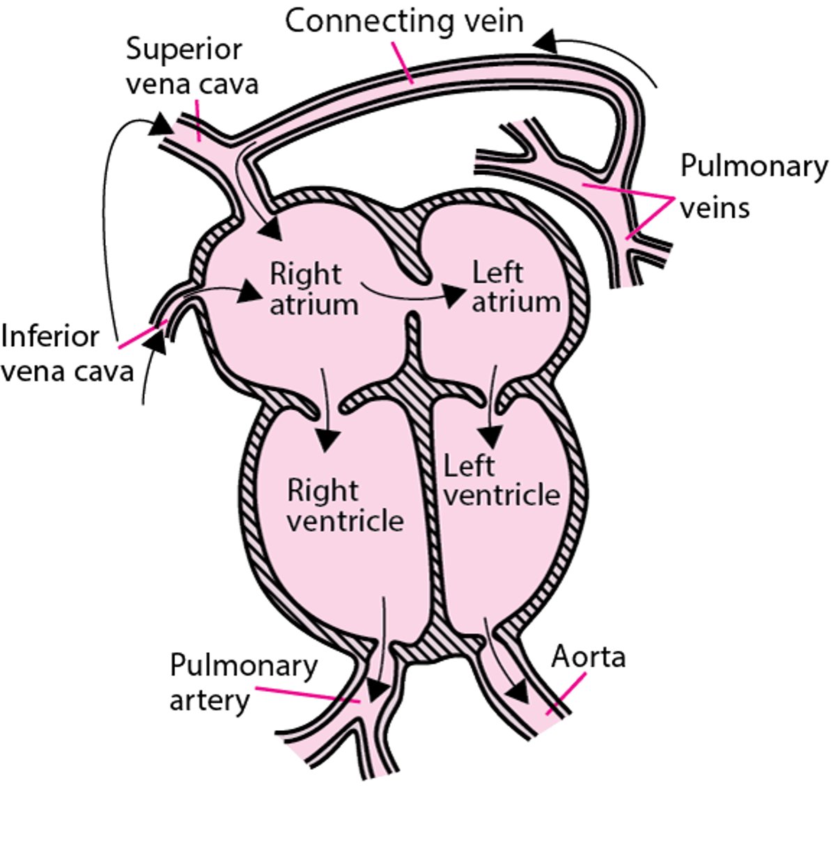 Retorno venoso pulmonar anómalo total