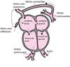 Retour veineux pulmonaire anormal total