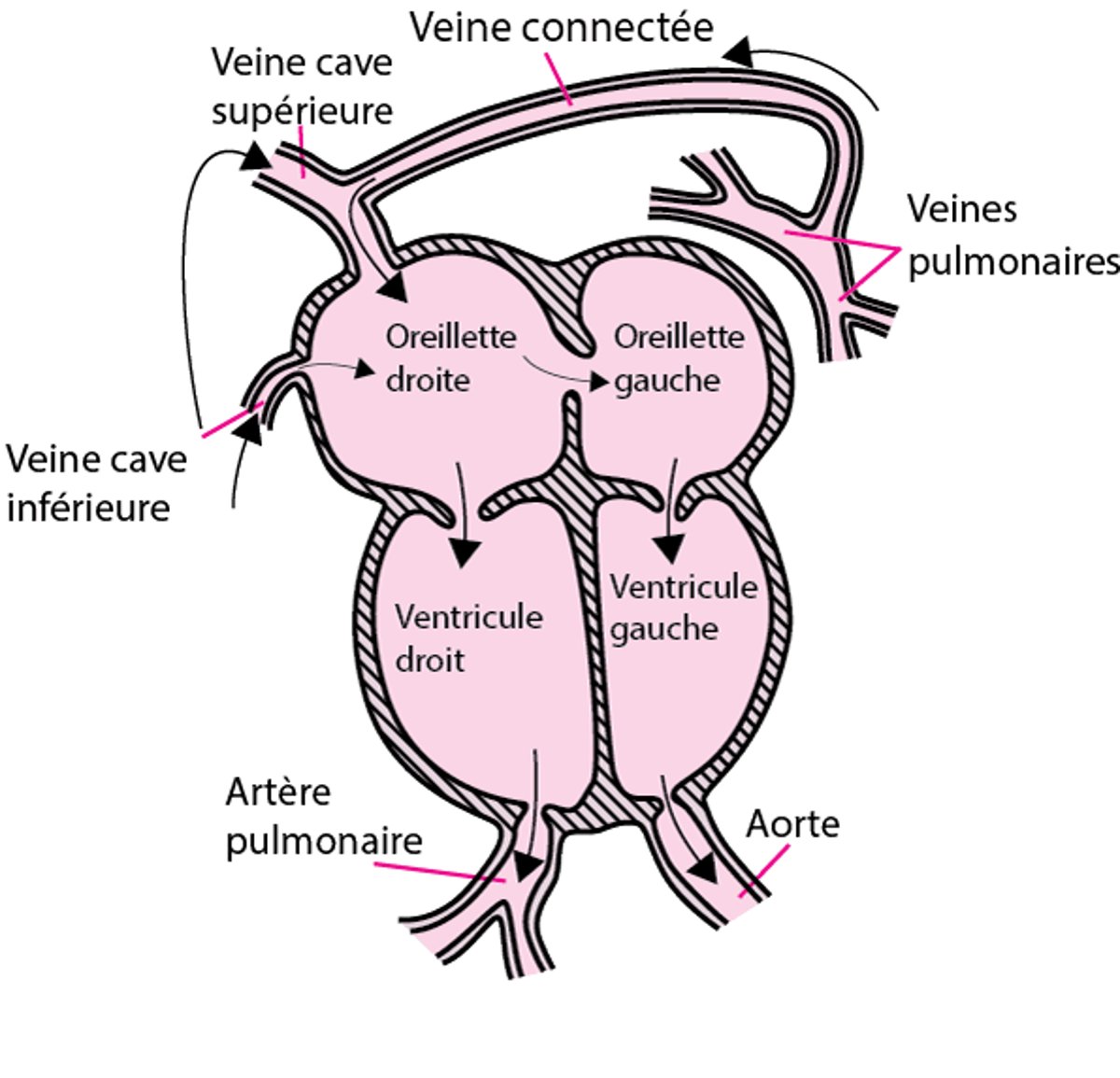 Retour veineux pulmonaire anormal total