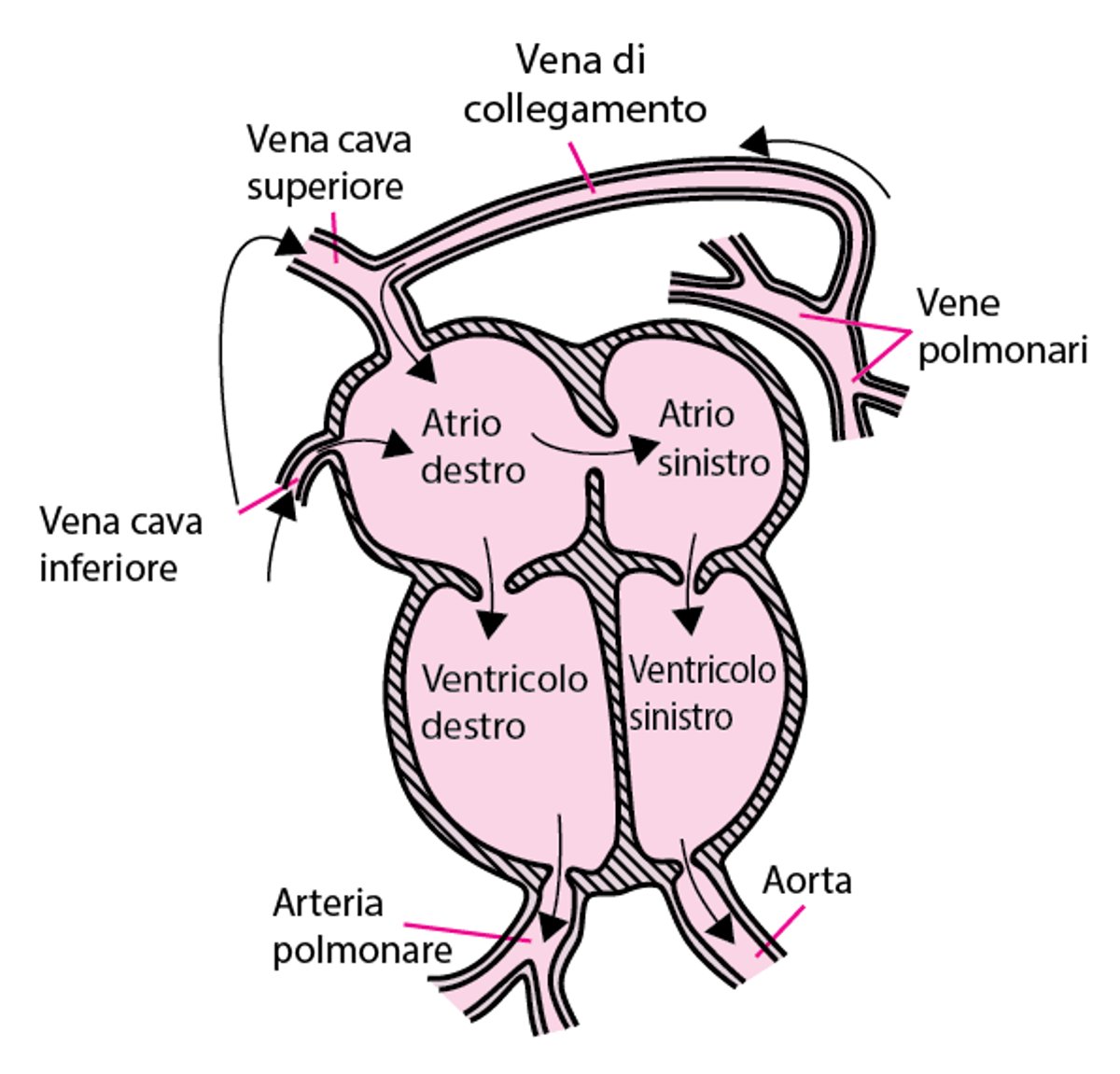 Ritorno venoso polmonare anomalo totale