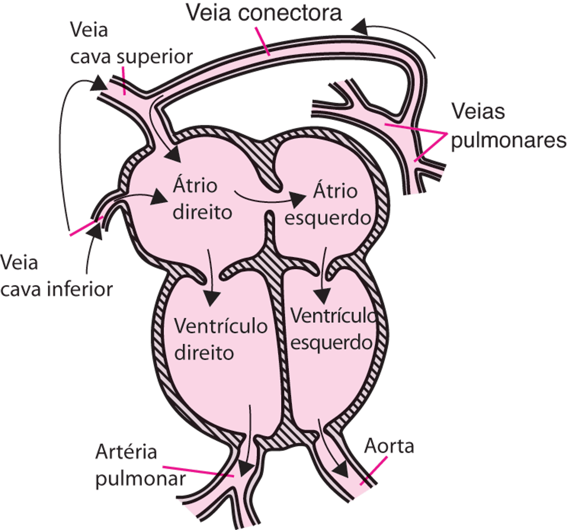 Drenagem anômala total de veias pulmonares