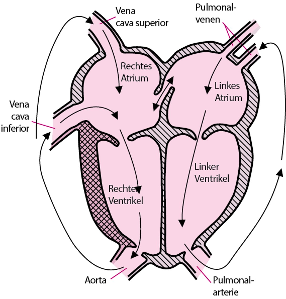 Transposition der großen Arterien