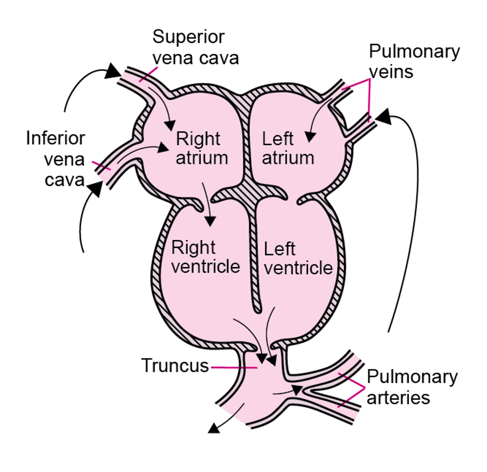 Persistent Truncus Arteriosus