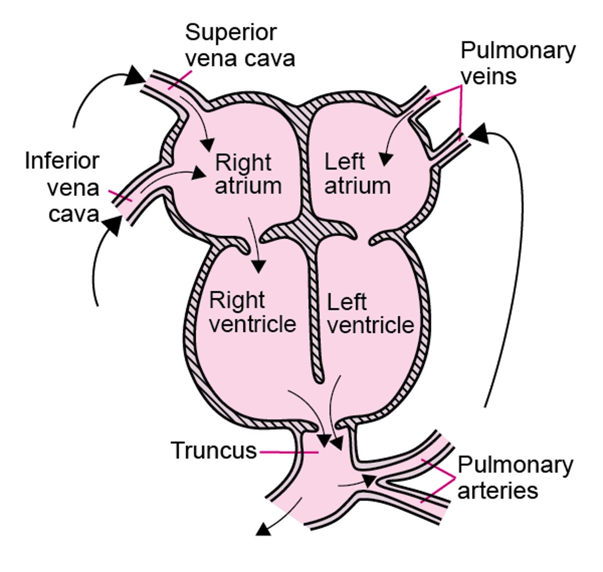 Tronco arterioso persistente