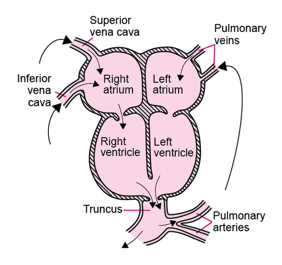 Persistance du tronc artériel commun