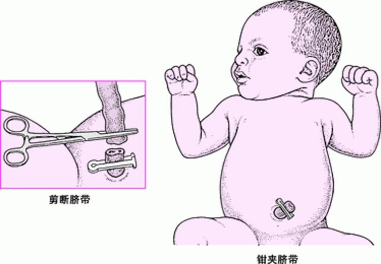 剪断脐带