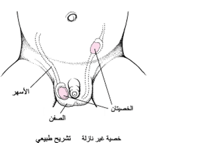 الخُصيَة غَير النازِلَة Undescended Testis