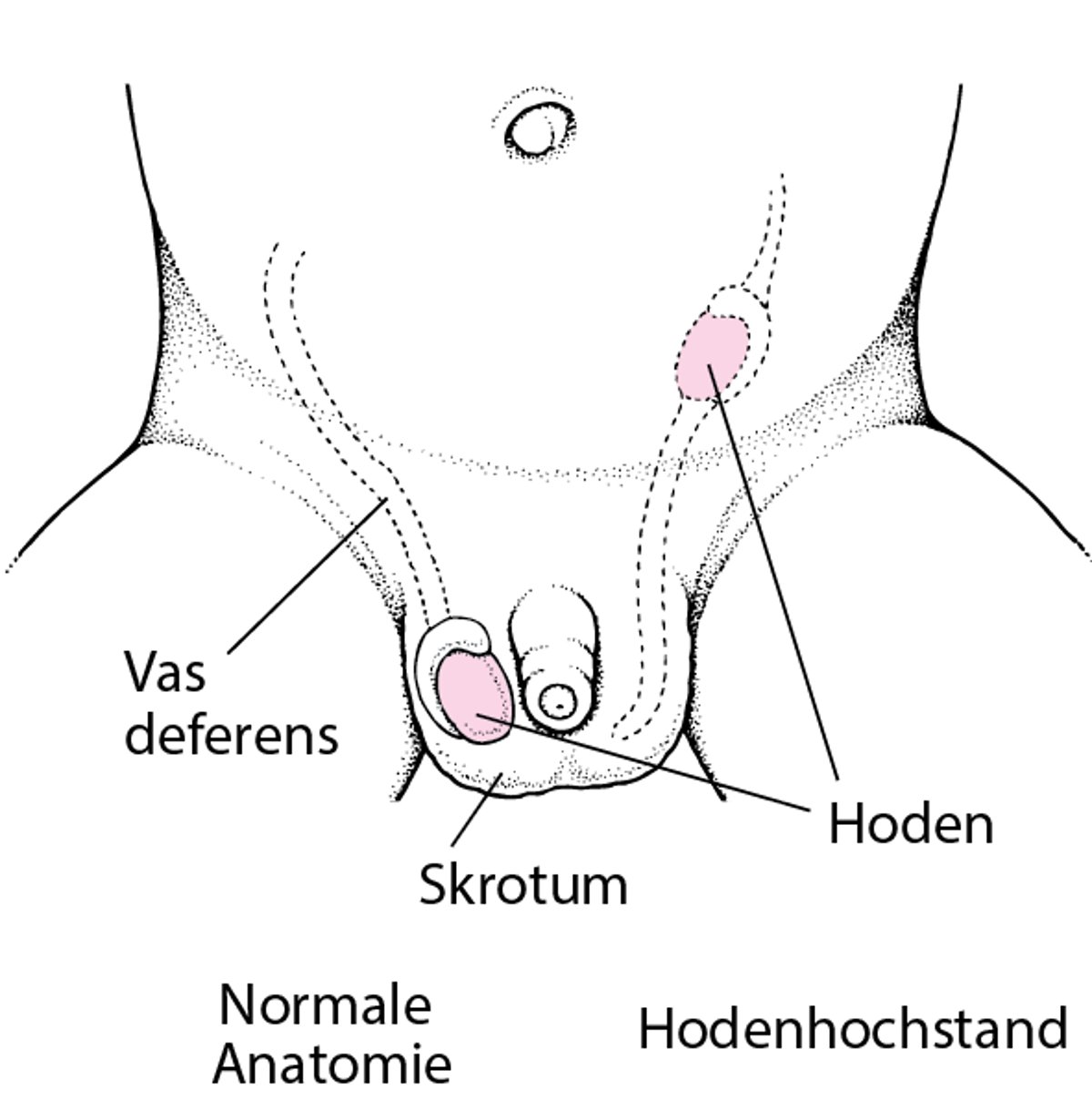 Hodenhochstand