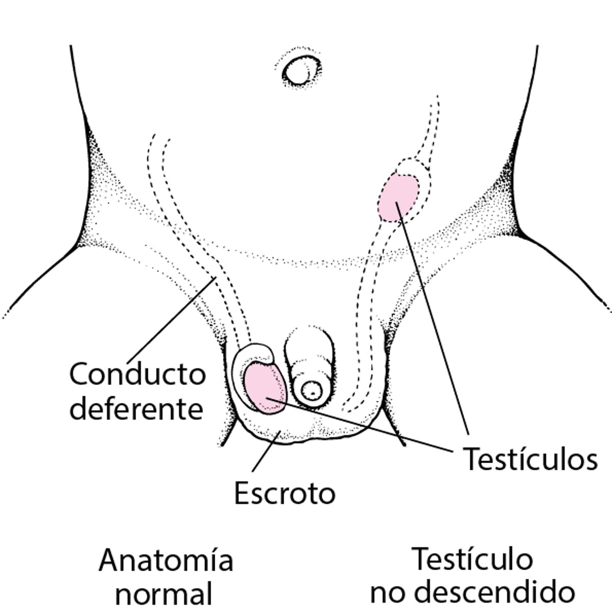 Testículos no descendidos
