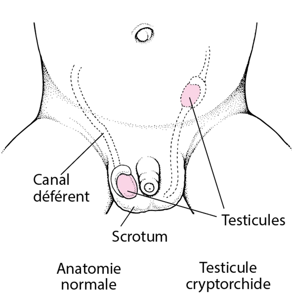 Testicule non descendu