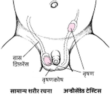 अन्डीसेंडेड टेस्टिस