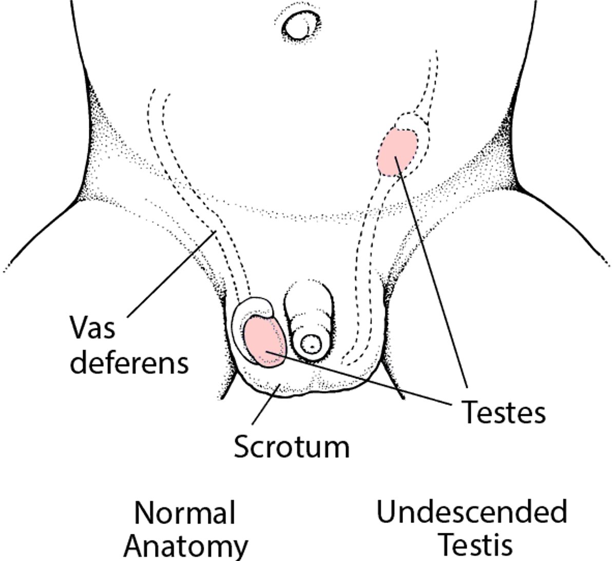 Testis yang Tidak Turun