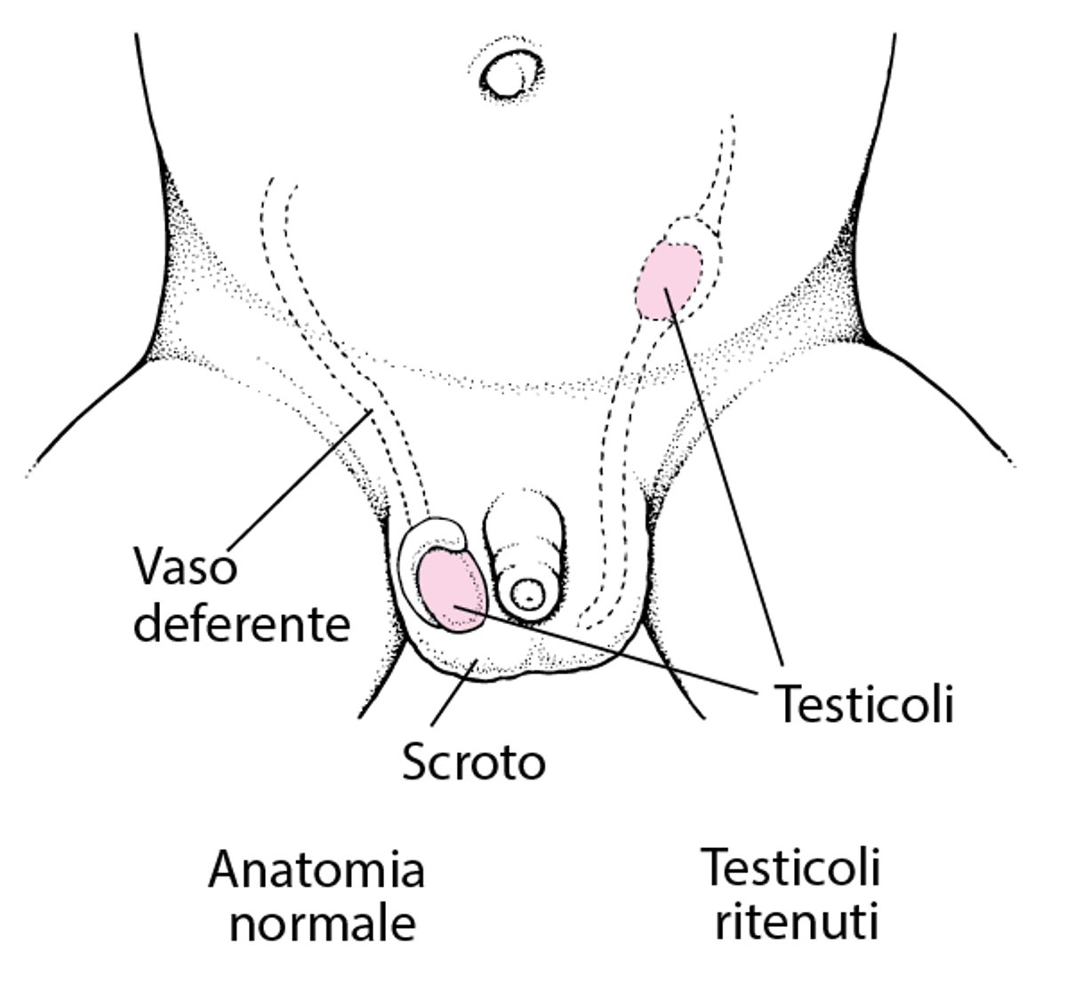 Testicoli ritenuti