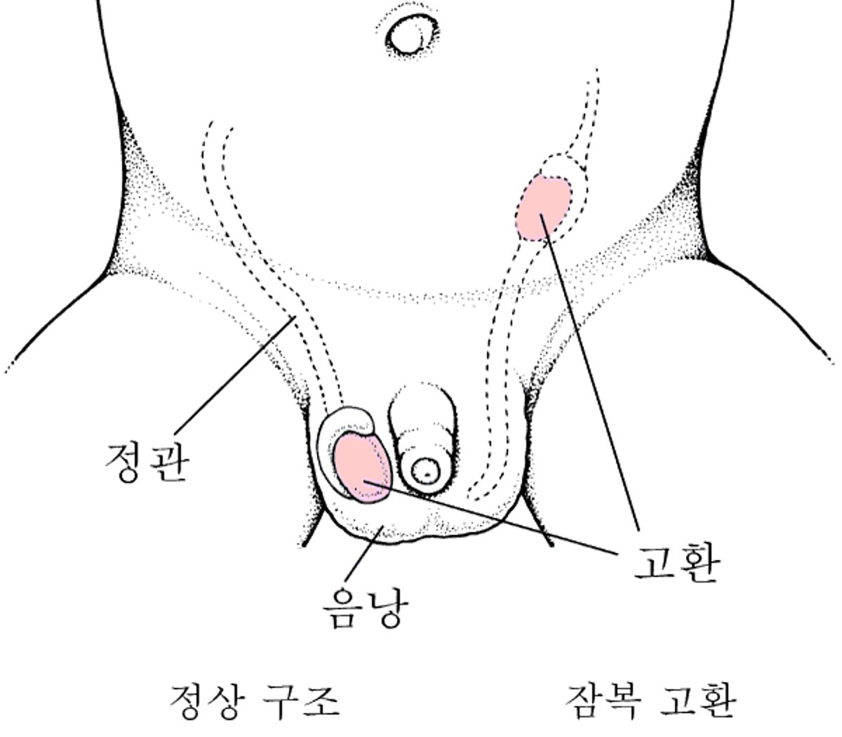 미하강 고환