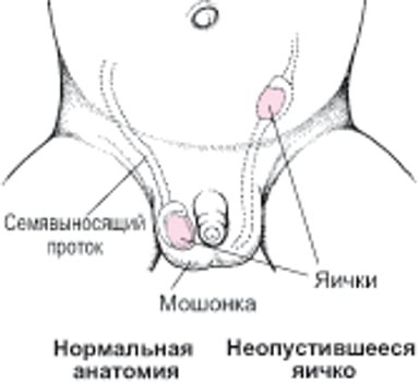 Неопустившееся яичко