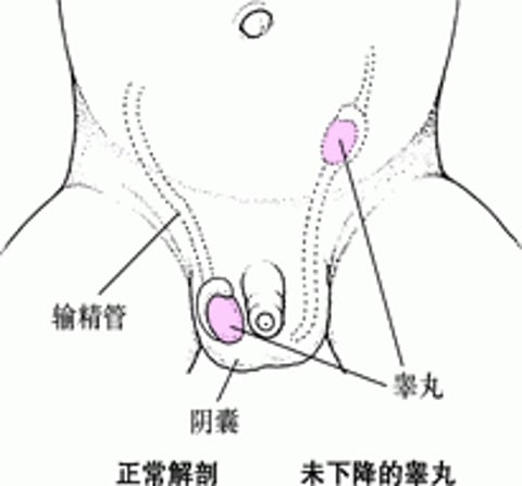 睾丸未降