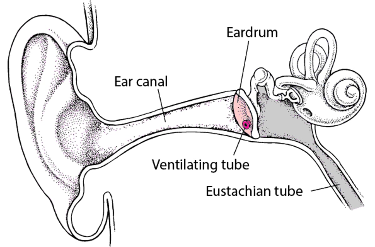 Myringotomy: Treating Secretory Otitis Media
