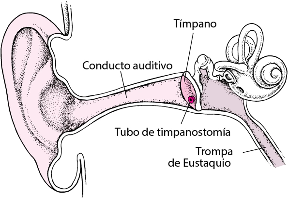 Miringotomía: tratamiento de la otitis media secretora