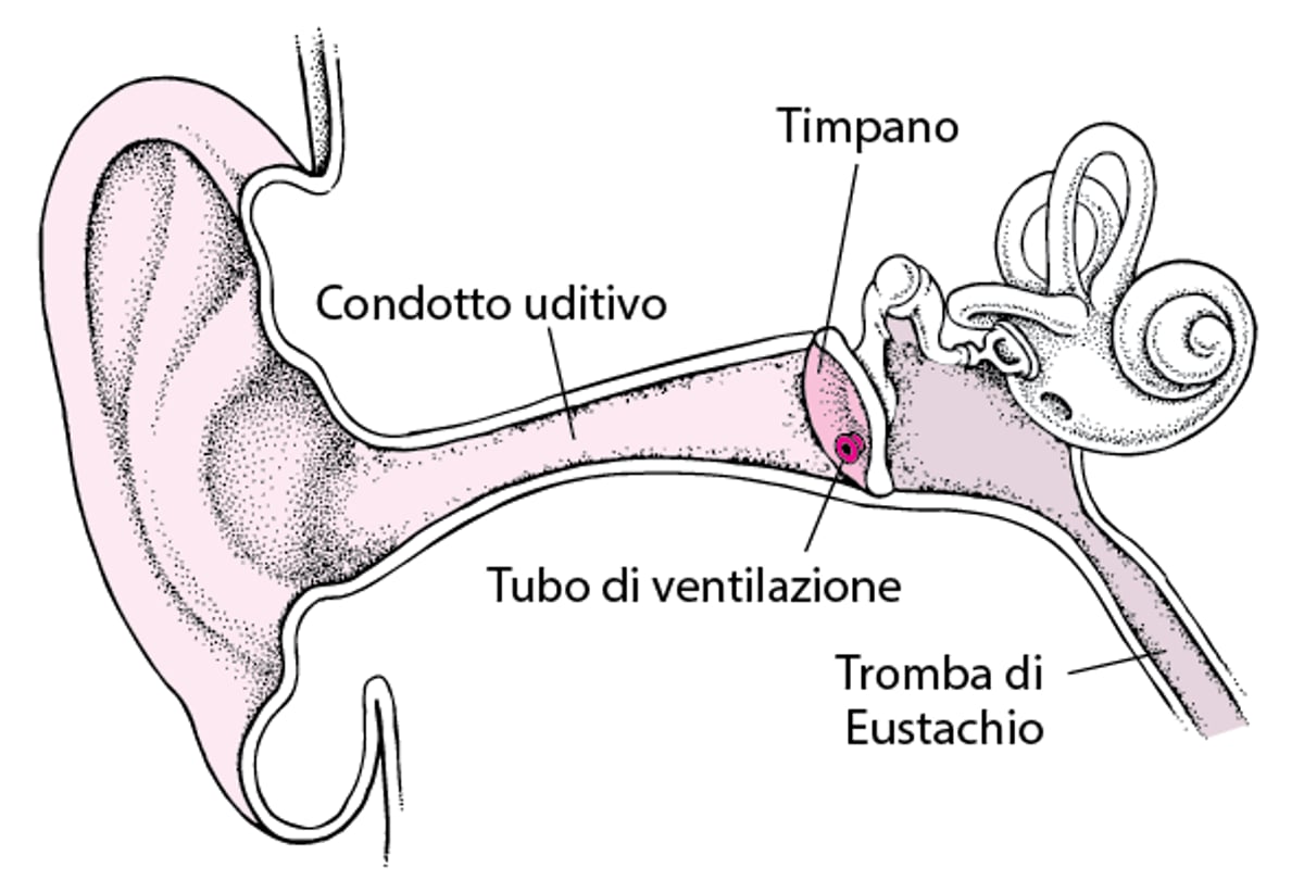 Miringotomia: Trattamento delle infezioni ricorrenti dell’orecchio