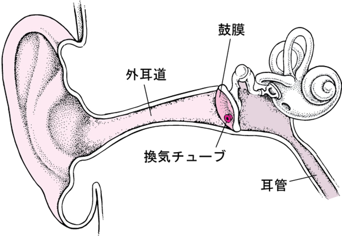 鼓膜切開術：繰り返し起こる耳の感染症の治療