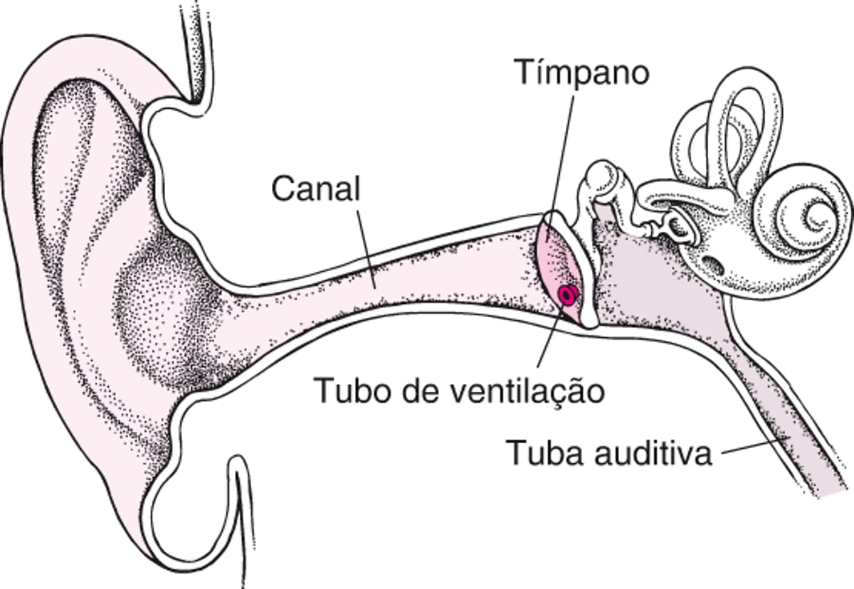 Miringotomia: Tratamento de infecções do ouvido recorrentes