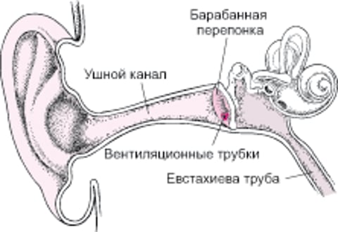 Миринготомия: лечение повторных ушных инфекций