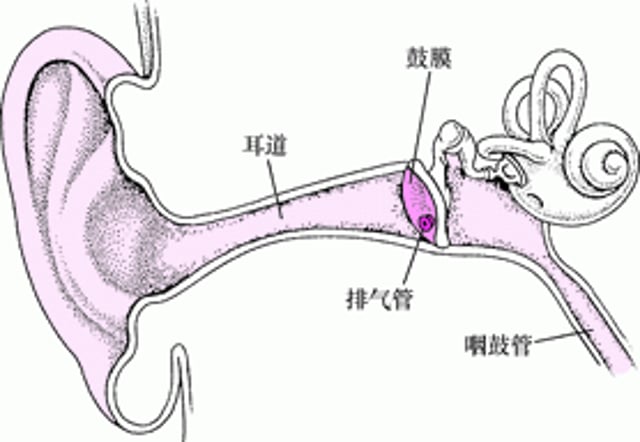 鼓膜切开术：治疗复发性耳部感染