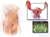 Pelvic Inflammatory Disease