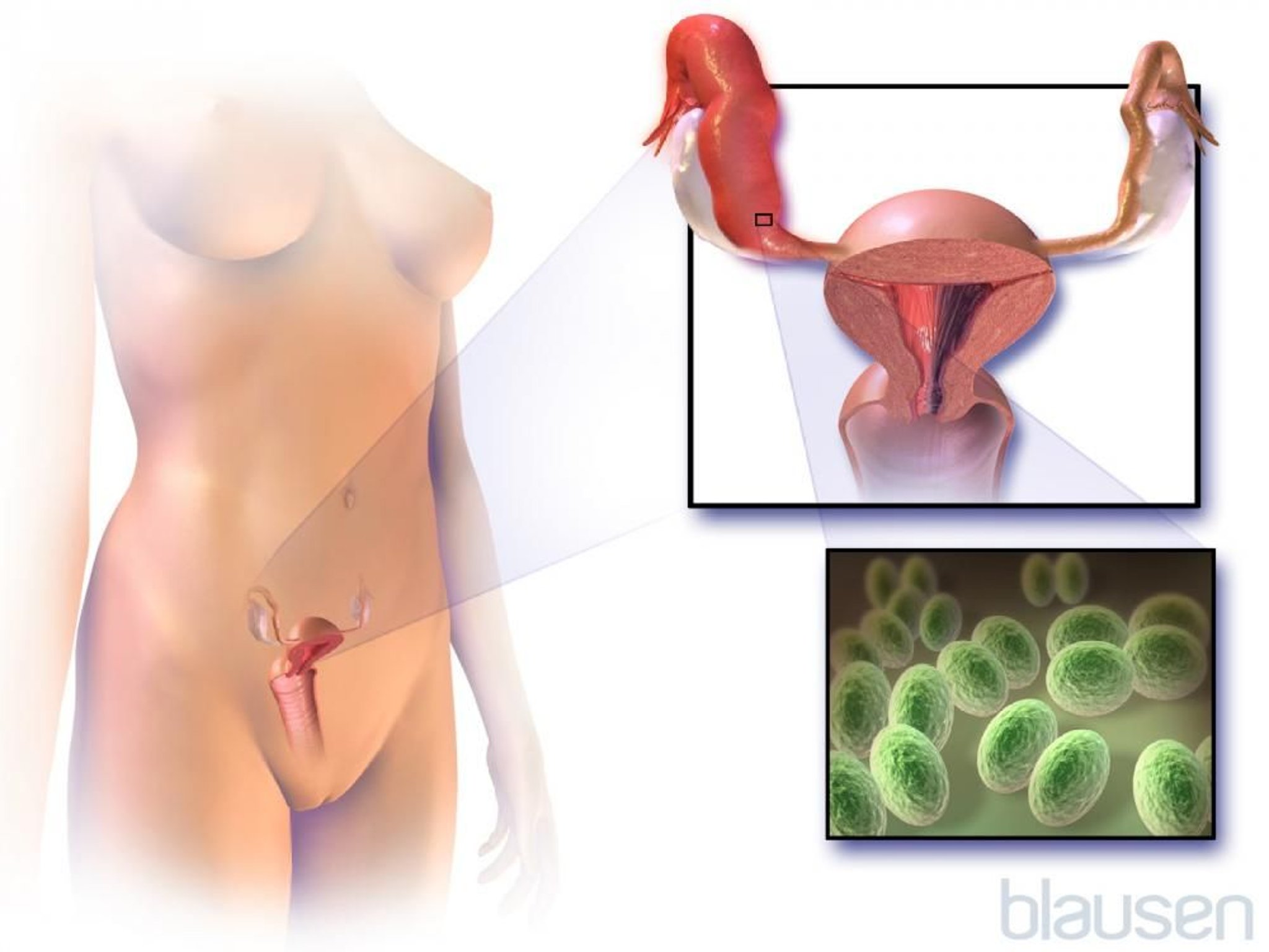 الداء الحوضي الالتهابي